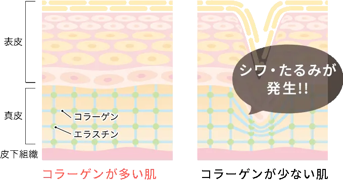 コラーゲンが多い肌と少ない肌のイメージ図
